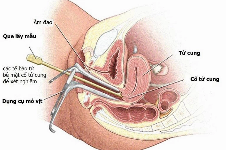 Bác sĩ đang sử dụng mỏ vịt để khám phụ khoa