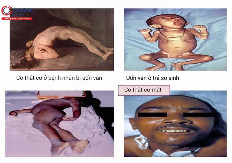 Uốn Ván: Hiểm Họa Khôn Lường và Cách Phòng Ngừa Toàn Diện Biến chứng nguy hiểm của bệnh uốn ván
