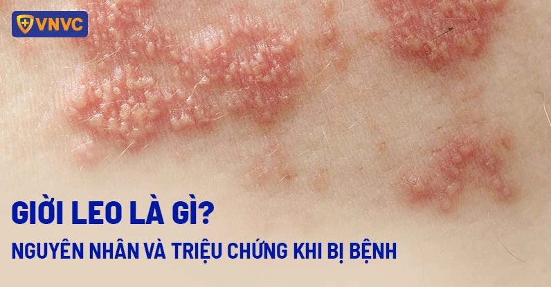 Cấu trúc virus Varicella-Zoster gây bệnh giời leo