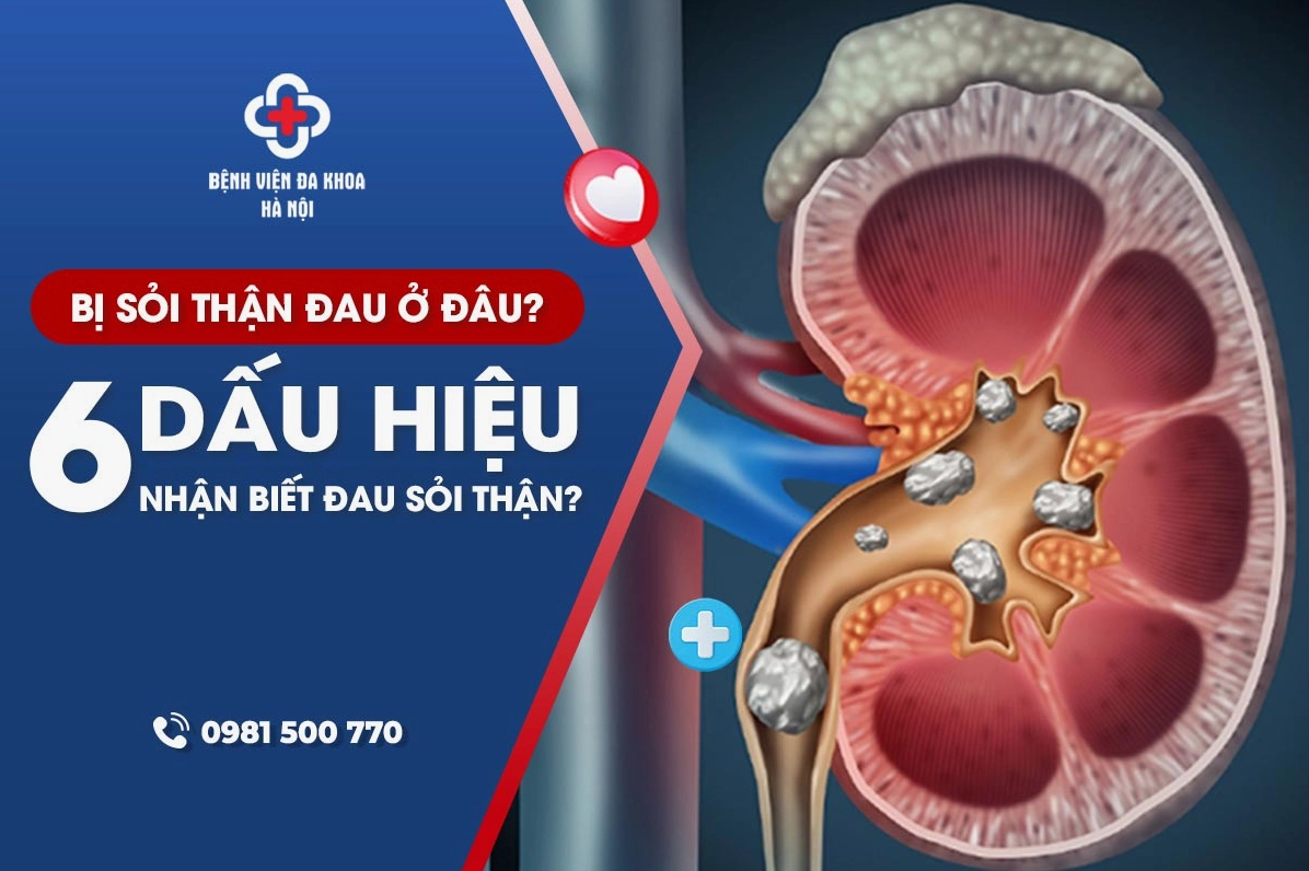 Dấu hiệu nhận biết sỏi thận