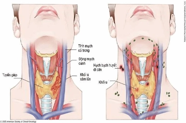 Tự Kiểm Tra Ung Thư Vòm Họng: Dấu Hiệu và Cách Thực Hiện Hình ảnh minh họa cấu trúc vòm họng và các tế bào ung thư