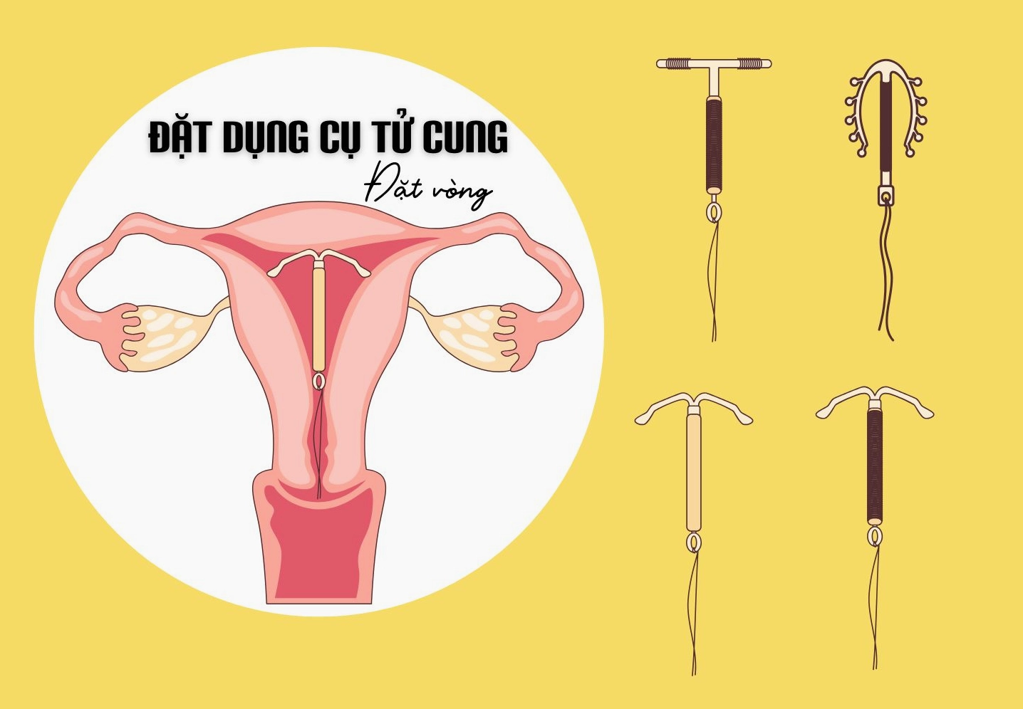 Quy trình đặt vòng tránh thai