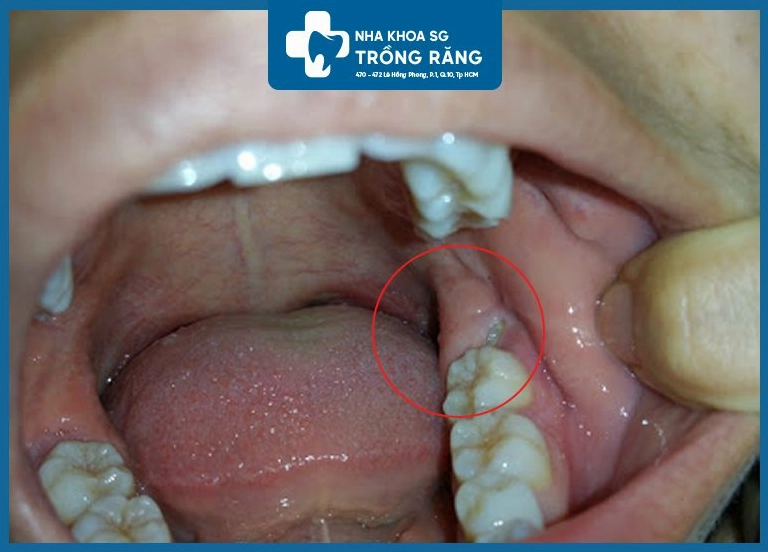Răng khôn mọc ngầm gây đau nhức