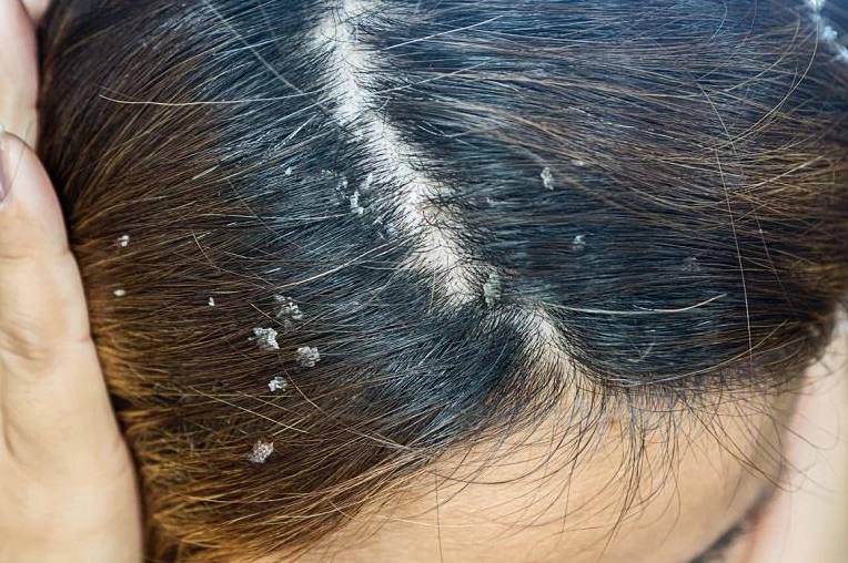 Sản phẩm dầu gội trị viêm da tiết bã da đầu