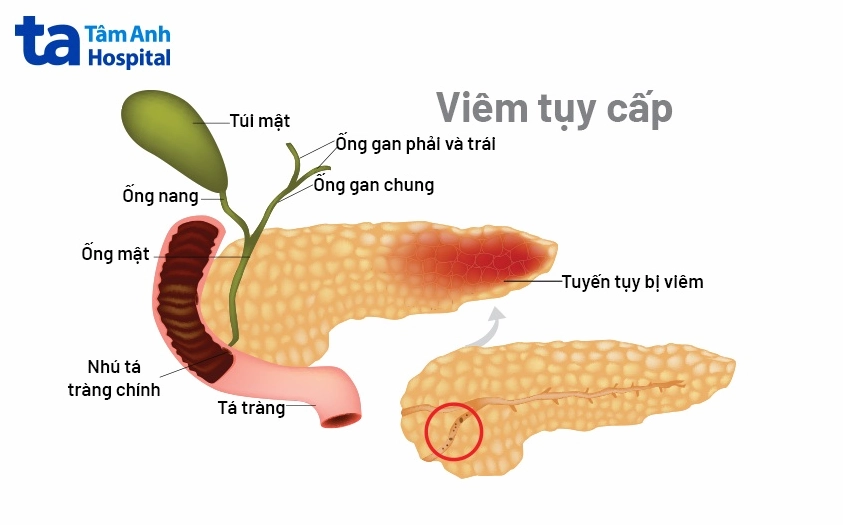 Tình trạng viêm tụy cấp