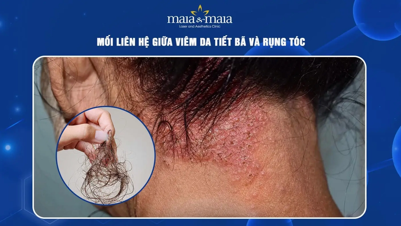 Tóc bị rụng do viêm da tiết bã da đầu