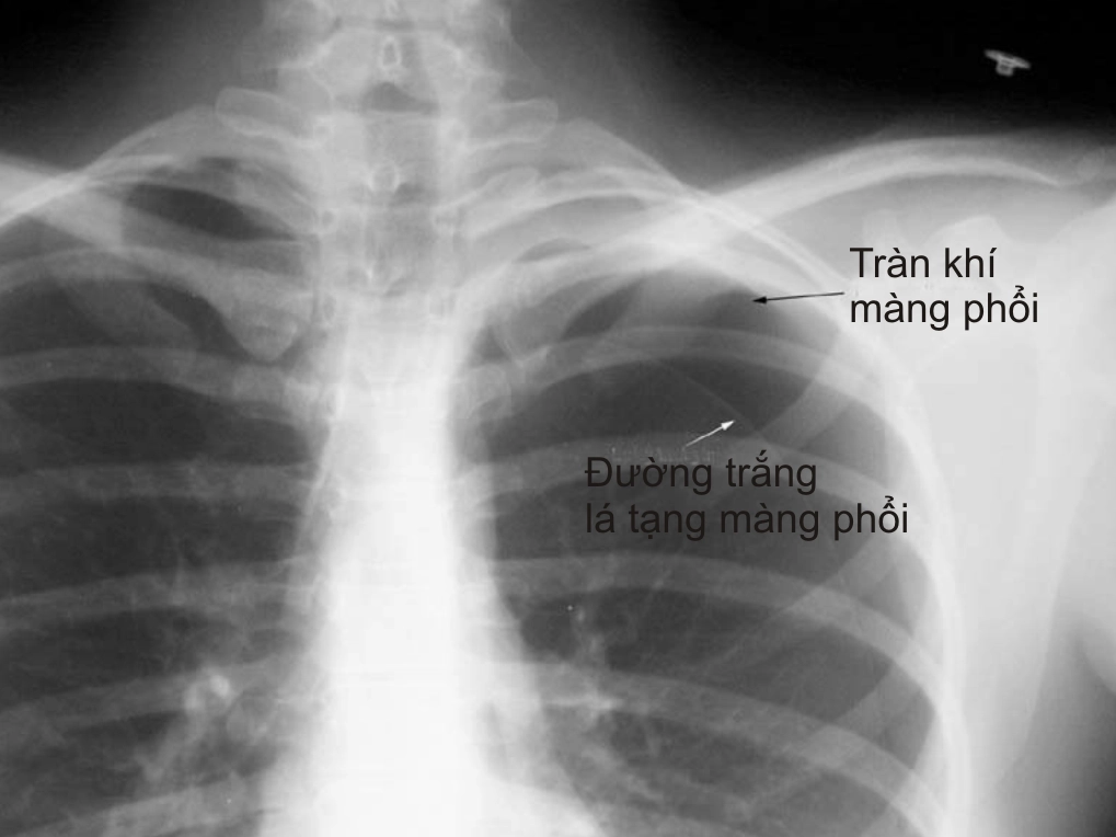tran-khi-mang-phoi-la-gi-nguyen-nhan-trieu-chung-cach-ieu-tr_548