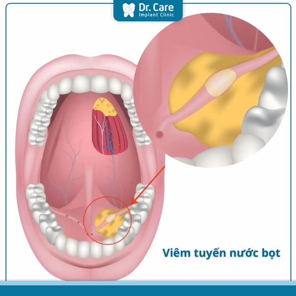tuyen-nuoc-bot-chuc-nang-benh-ly-va-cach-cham-soc-toan-dien-_883
