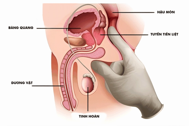 Tuyến Tiền Liệt Ở Đâu? Vị Trí, Chức Năng Và Cách Chăm Sóc Vị trí của tuyến tiền liệt được minh họa trên cơ thể nam giới