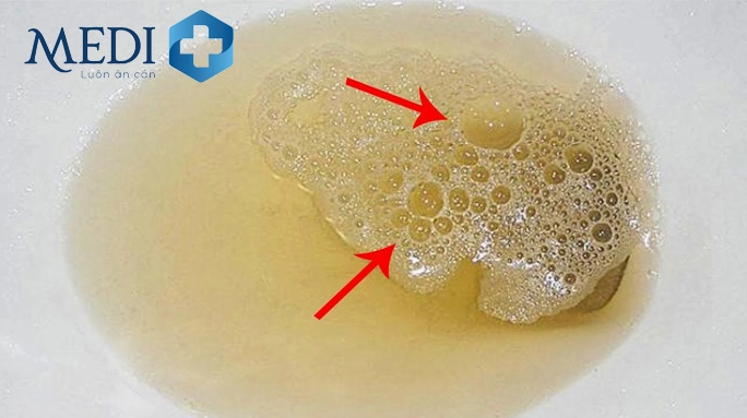 Đi tiểu với lực mạnh có thể gây bọt