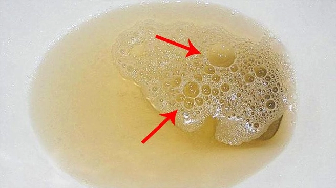 Nước Tiểu Như Thế Nào Là Bình Thường? Dấu Hiệu Cần Quan Tâm Màu sắc nước tiểu bình thường